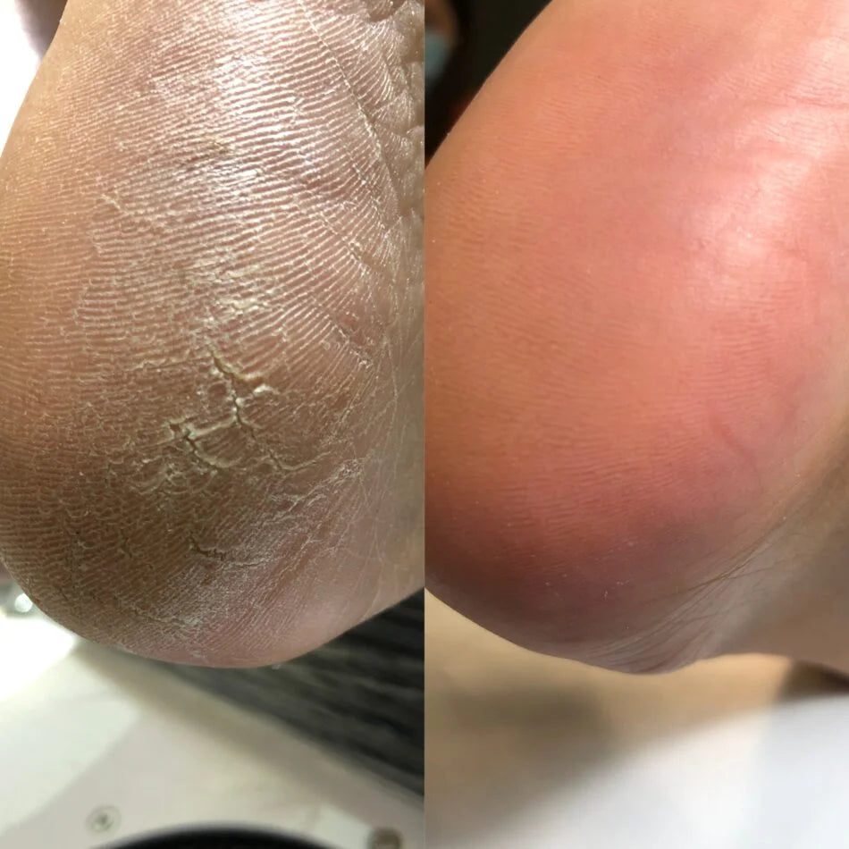Nails Of The Day Podology+ Keratolytic for feet, 100 ml