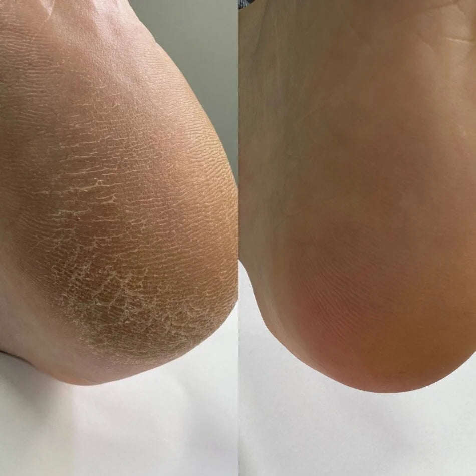 Nails Of The Day Podology+ Keratolytic for feet, 100 ml
