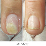 Nails Of The Day Onistop Regenerating Oil Against Onycholysis, 8 ml