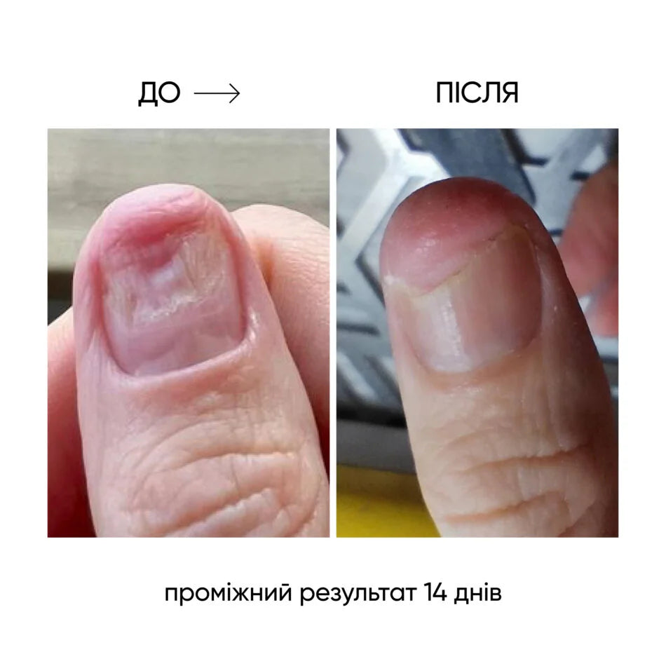 Nails Of The Day Onistop Regenerating Oil Against Onycholysis, 15 ml