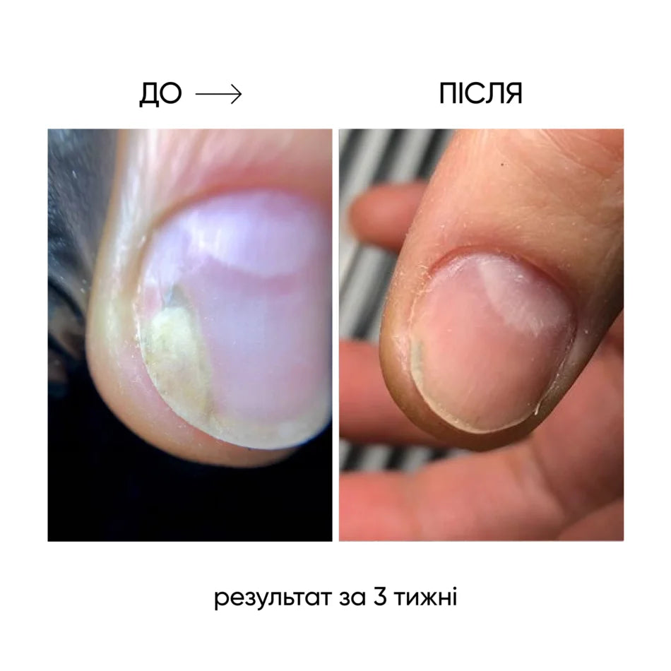 Nails Of The Day Onistop Regenerating Oil Against Onycholysis, 8 ml