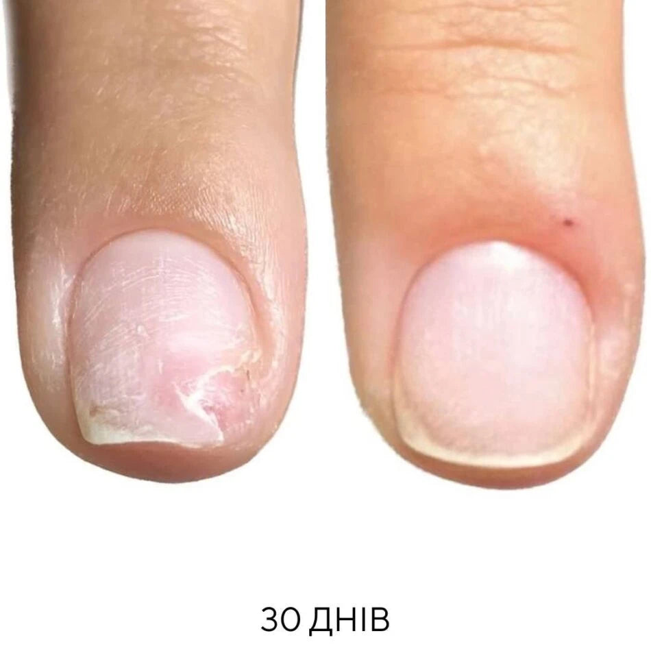 Nails Of The Day Onistop Regenerating Oil Against Onycholysis, 15 ml