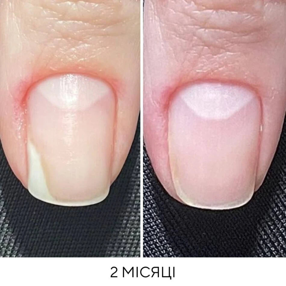 Nails Of The Day Onistop Regenerating Oil Against Onycholysis, 15 ml