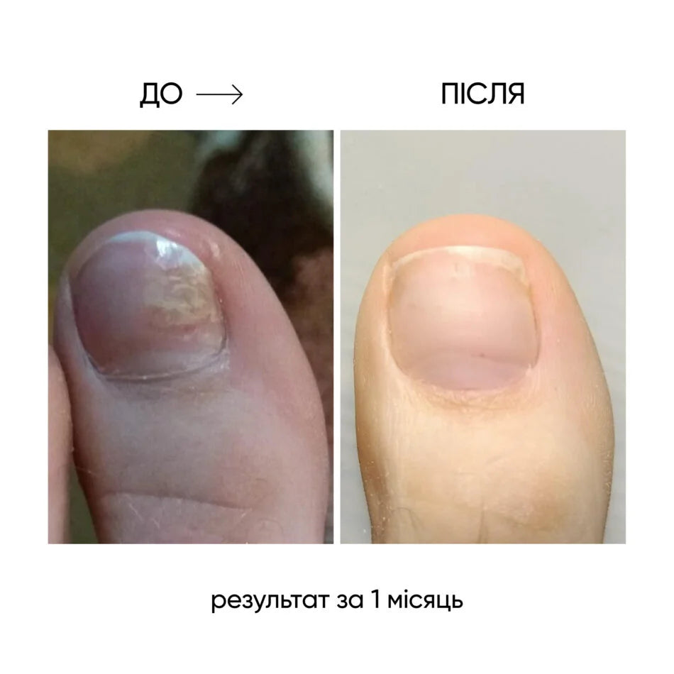 Nails Of The Day Onistop Regenerating Oil Against Onycholysis, 8 ml
